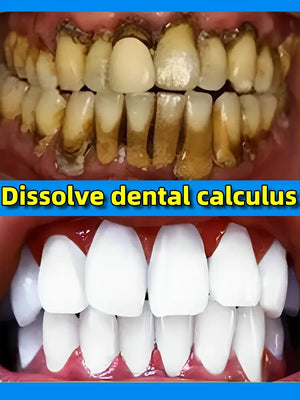 Remover Dental Calculus Whitening Teeth Mouth Odor Brightening Preventing Periodontitis  Removal Bad Breath Dental Clean Care