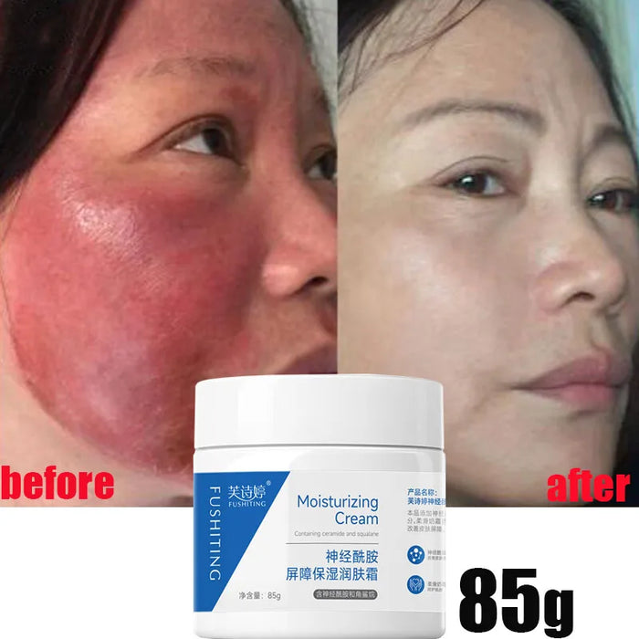Facial Redness Treatment Cream Instant Rosacea Red Blood Repair Pruducts Anti Redness Spider Vein Sensitive Skin Barrier Care