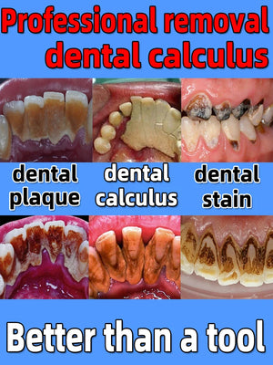 Remover Dental Calculus Whitening Teeth Mouth Odor Brightening Preventing Periodontitis  Removal Bad Breath Dental Clean Care