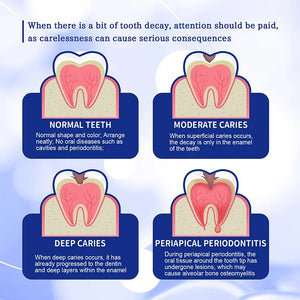 30g Anti Decay Toothpaste Dental Caries Repair Cream Prevent Tooth Decay Removing Dental Calculus Protect Teeth Freshens Breath