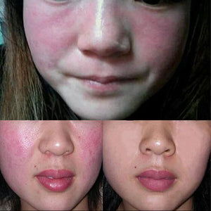Facial Redness Treatment Cream Instant Rosacea Red Blood Repair Pruducts Anti Redness Spider Vein Sensitive Skin Barrier Care