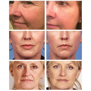 Collagen Smile Line Gel Patch Lifting Firming Relief Sagging Mouth Wrinkle Treatment Anti Aging Tighten Sticker Korean Skin Care