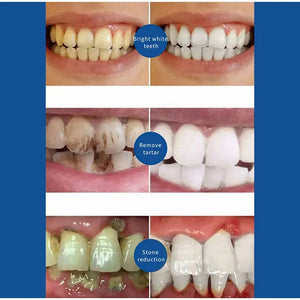 Dental Calculus Remove Whitening Teeth Toothpaste Brightening Preventing Periodontitis Removal Bad Breath Dental Cleansing Care