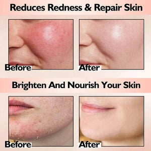 Facial Redness Repair Serum Against Redness Rosacea Spider Vein Treatment Sensitive Skin Shrink Pore Korean Face Skin Care Cream