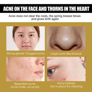 Snail Face Cream Anti Redness Pimple Removal Shrink Pores Repair Sensitive Skin Replenishing Moisturizer Acne Treatment Cream