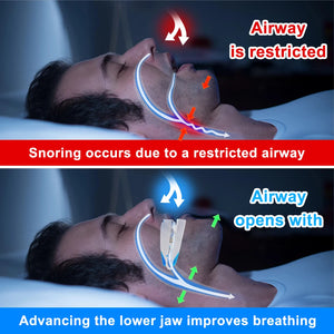 Adjustable Anti-Snoring Mouth Guard Prevent Teeth Grinding During Sleep Anti Snoring Device Improve Sleep Snoring Stopper