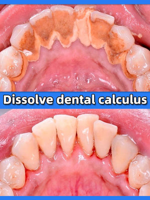 Remover Dental Calculus Whitening Teeth Mouth Odor Brightening Preventing Periodontitis  Removal Bad Breath Dental Clean Care