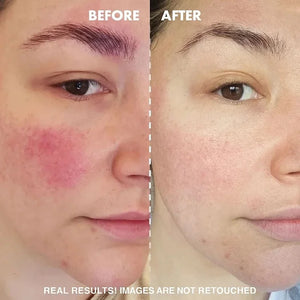 Facial Redness Repair Serum Against Redness Rosacea Spider Vein Treatment Sensitive Skin Shrink Pore Korean Face Skin Care Cream