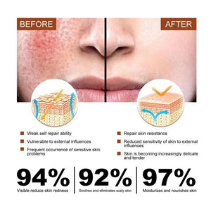 Facial Redness Treatment Cream Instant Rosacea Red Blood Repair Pruducts Anti Redness Spider Vein Sensitive Skin Barrier Care