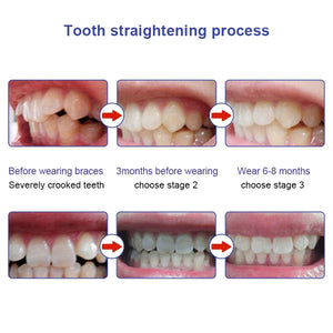 1/3PCS Teeth Corrector Tooth Orthodontic Trainer Fake Braces Trainer for Teeth Alignment 3 Phases for Adults Tooth Care Tools
