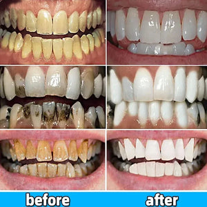 Dental Calculus Remover Teeth Whitening Toothpaste Removal Bad Breath Preventing Periodontitis Dental Brightening Oral Cleaning