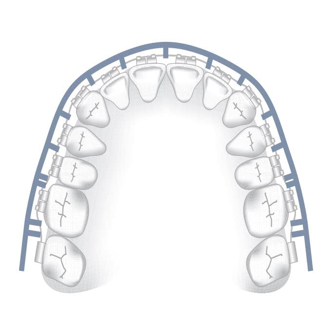 Clip-on Comfort Covers for Braces, Orthodontic Mouth Guard for Braces ...
