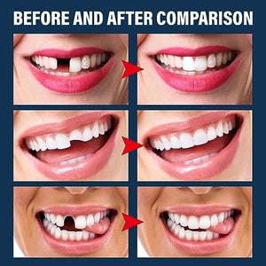 120 Pieces Dental Fake Tooth Cap Crown Veneers Front Back Anterior and Molar Posterior Teeth with Tooth Repair Thermal Beads Cap Filler for Missing Broken Teeth